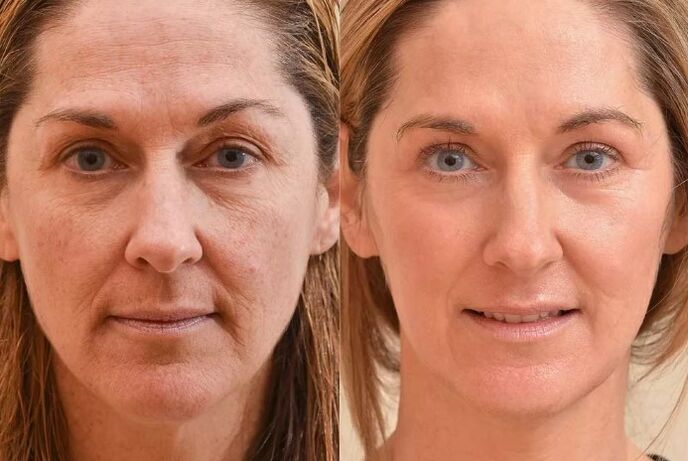 Rejuvenecimiento de la cara antes y después