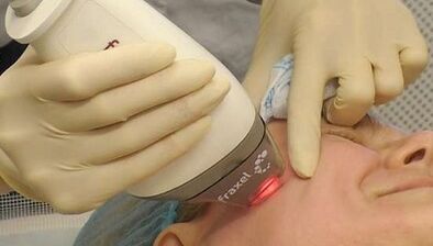 ¿Cómo se realiza el rejuvenecimiento cutáneo fraccionado