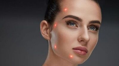 ¿Qué es el rejuvenecimiento fraccionado de la piel