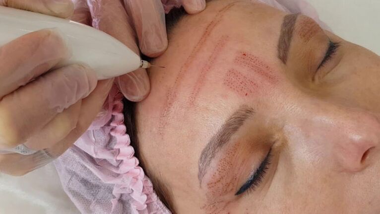 Rejuvenecimiento facial con plasma