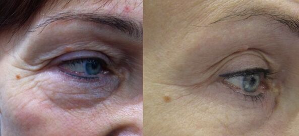 El resultado de un eficaz rejuvenecimiento con plasma del área alrededor de los ojos. 