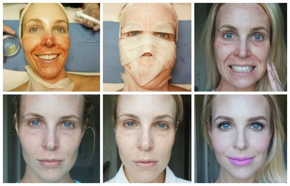 Etapas de curación de la piel del rostro después de un lifting con plasma exitoso