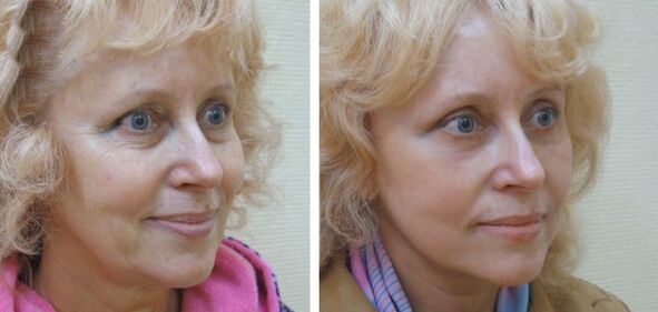 Mujer antes y después del rejuvenecimiento cutáneo del rostro con plasma. 