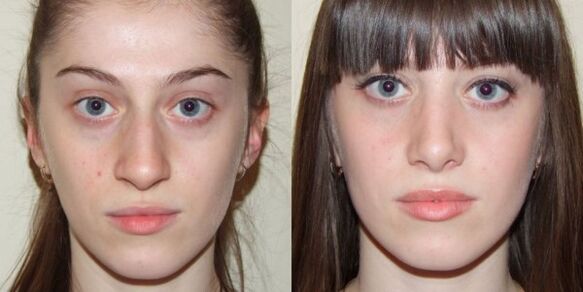 Niña antes y después del rejuvenecimiento de la piel del rostro con plasma. 