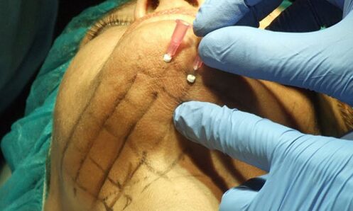 Levantamiento de hilos una técnica mínimamente invasiva para el rejuvenecimiento de la piel del rostro